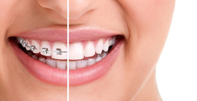 Diş Teli Tedavisinde Beslenme Nasıl Sağlanır?